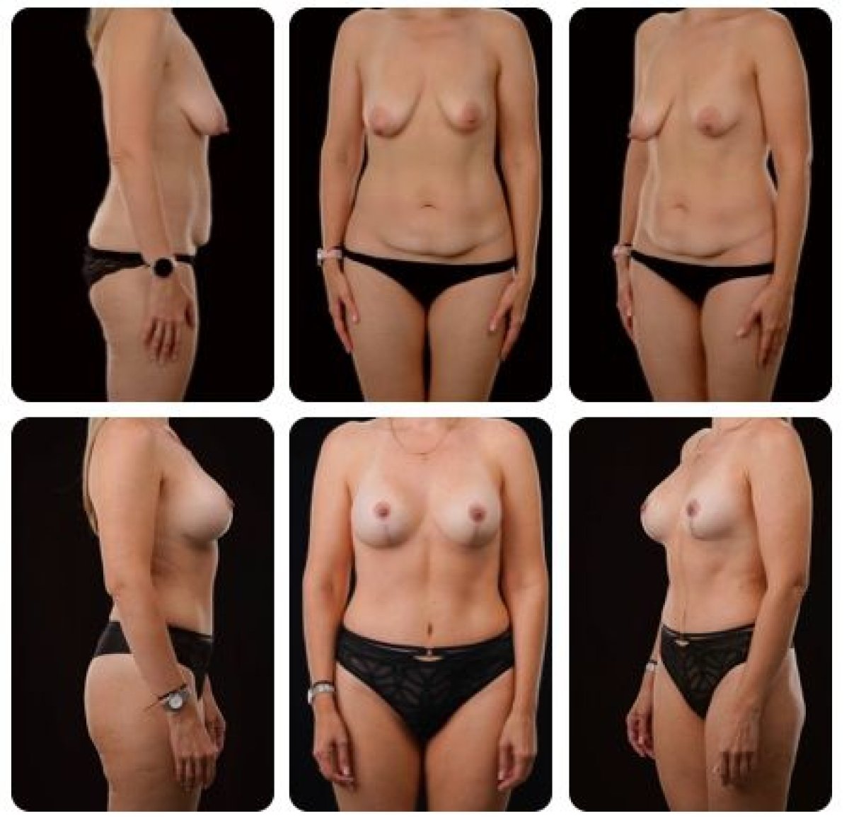 Efekty przed i po liftingu piersi w Yurchenko Plastic Surgery Team Kyiv, poprawiony kontur