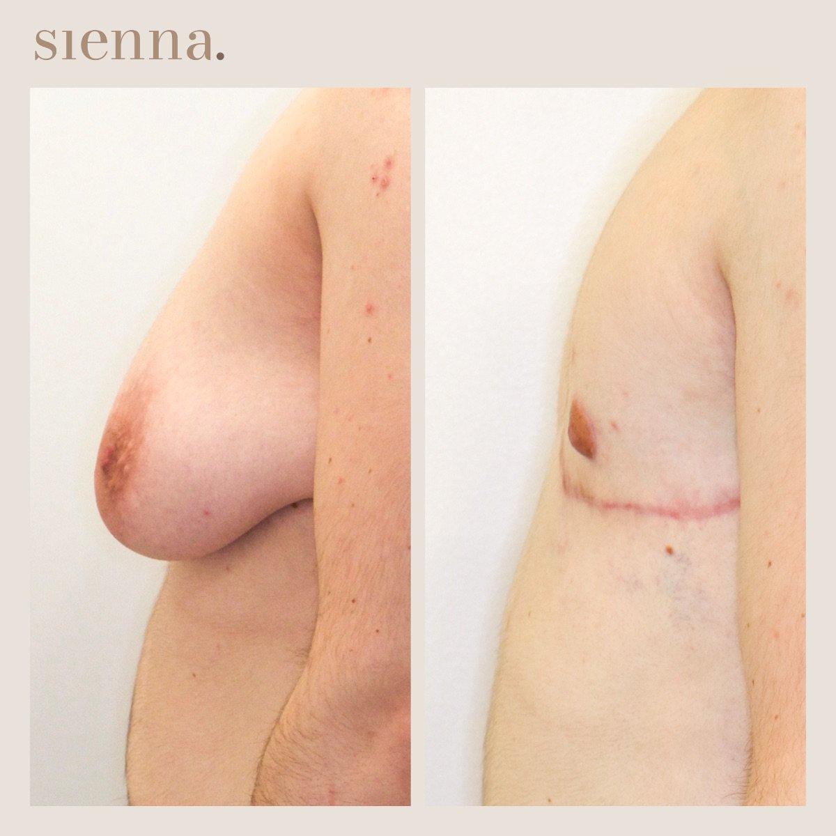 Результаты топ-операции до и после в Sienna Clinic – маскулинизация груди