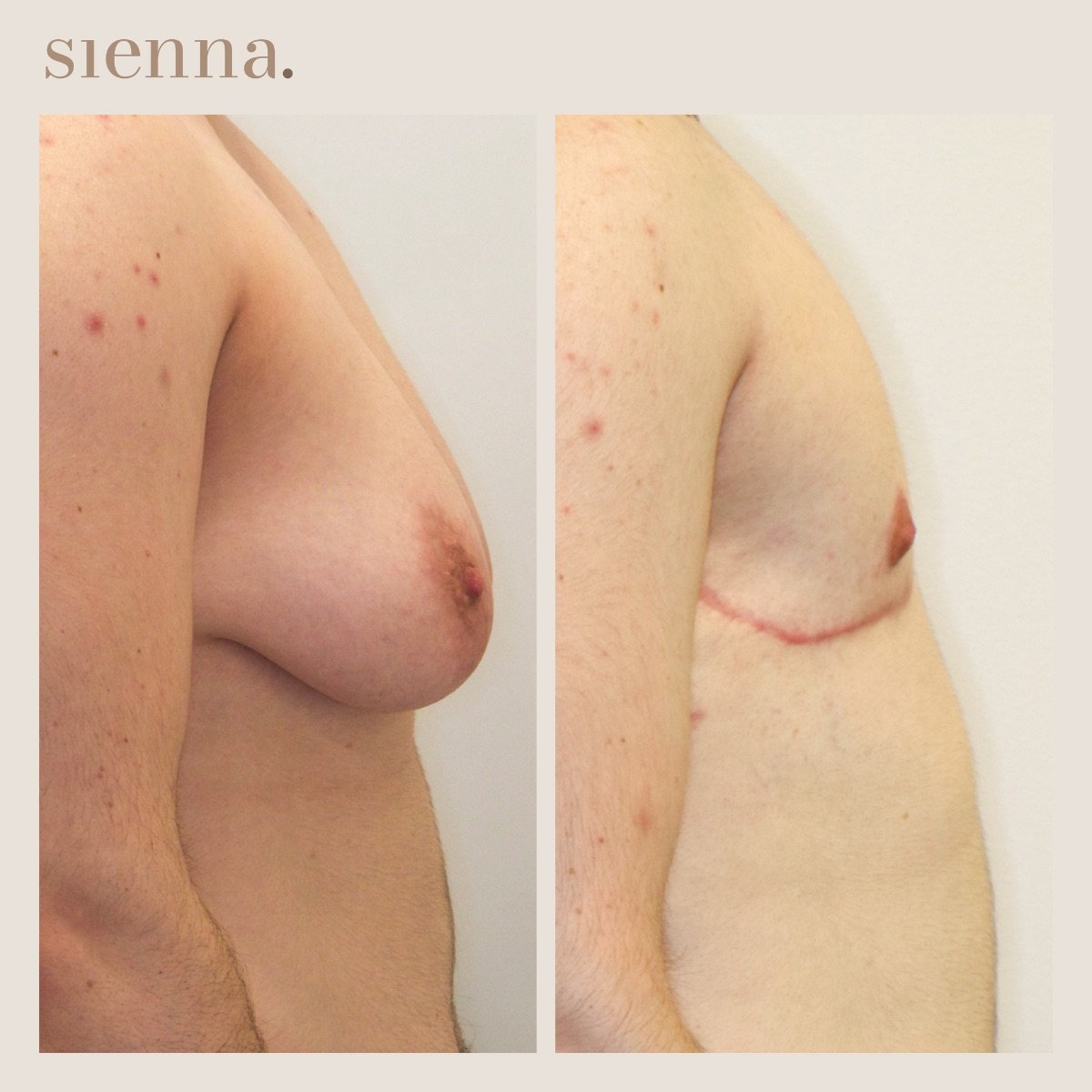نتائج قبل وبعد جراحة الصدر في Sienna Clinic – تحول تذكير الصدر