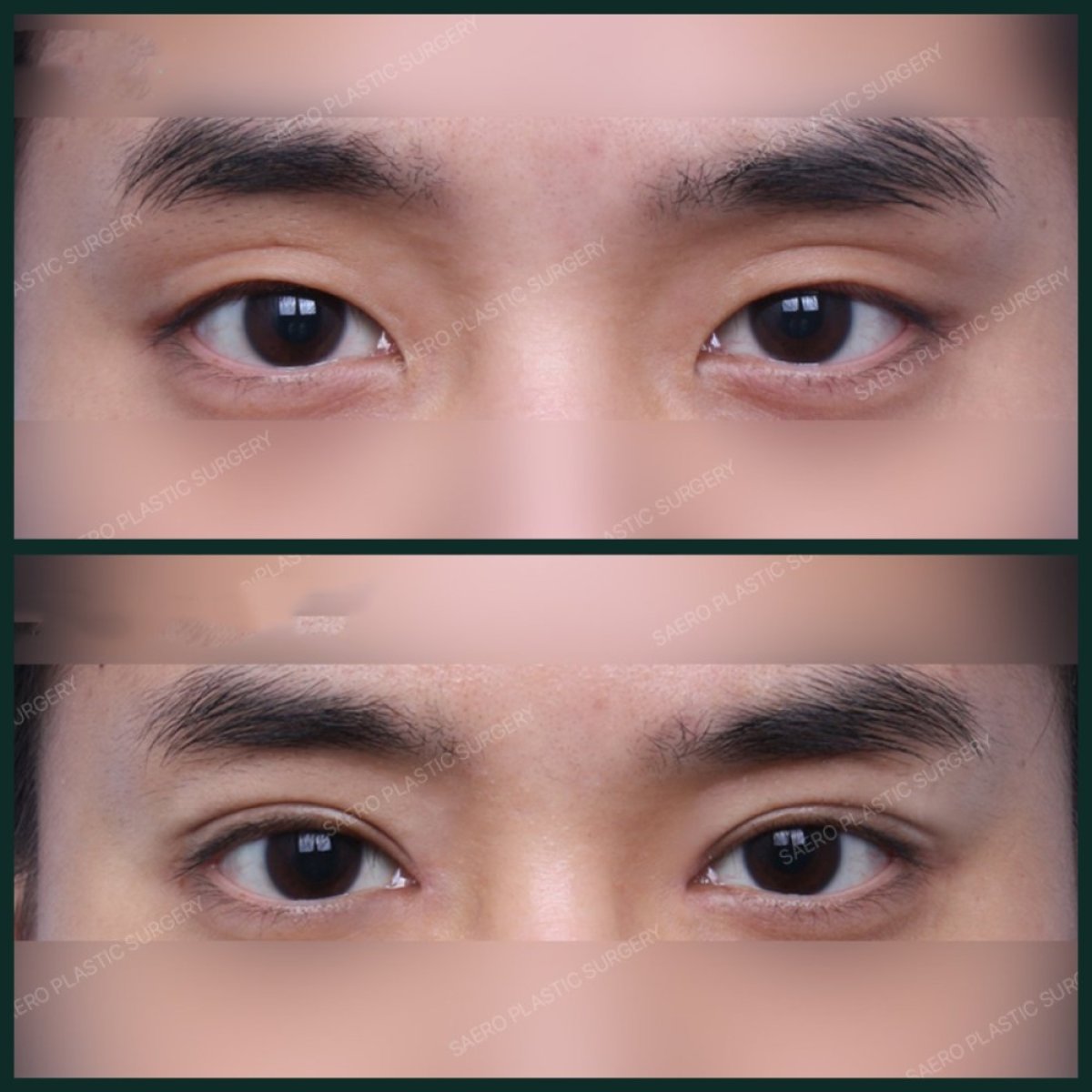 Resultados antes y después de cirugía de doble párpado en SAERO Plastic Surgery, pliegue natural