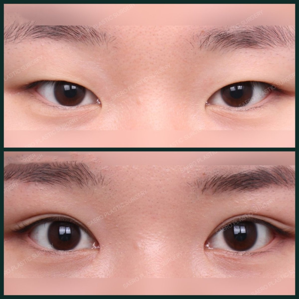 Before and after double eyelid surgery results at SAERO Plastic Surgery, enhanced eye contour