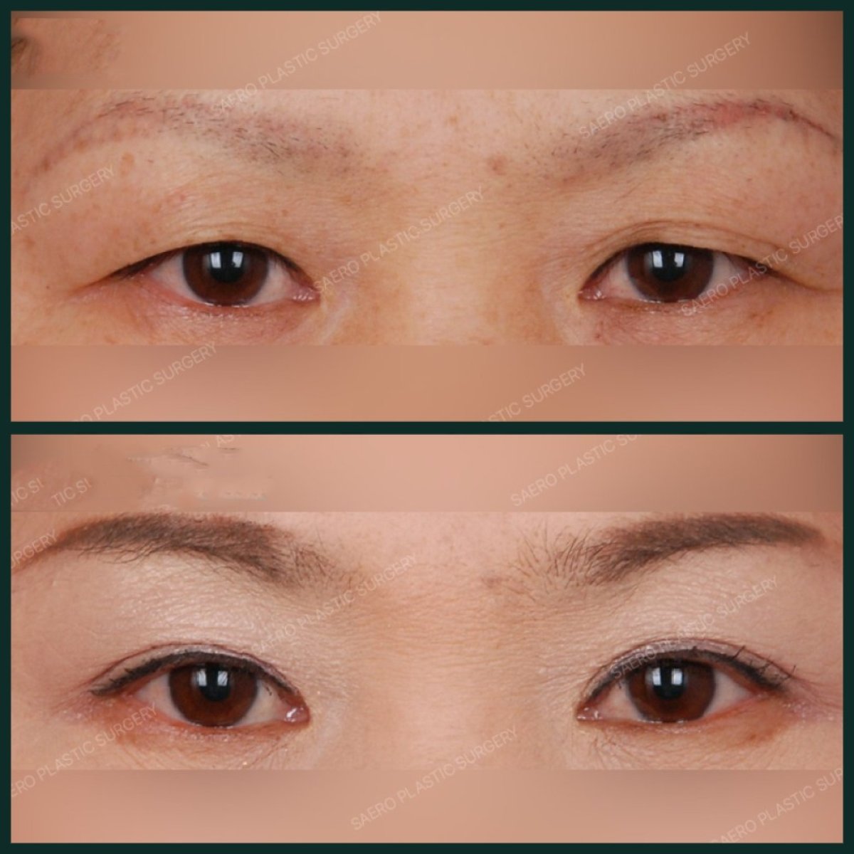 Resultados antes y después de cirugía de doble párpado en SAERO Plastic Surgery, pliegue mejorado