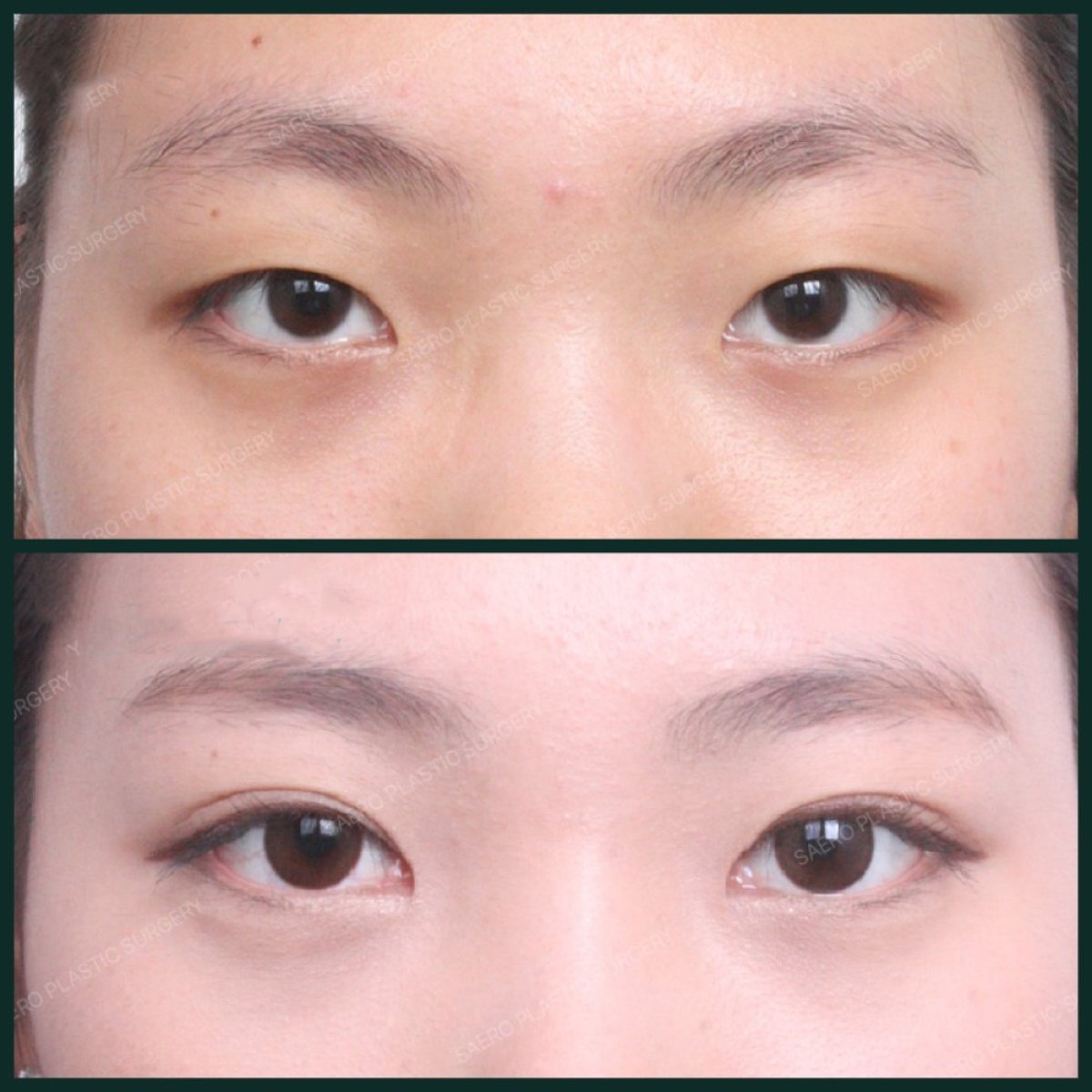 Before and after double eyelid surgery results at SAERO Plastic Surgery, enhanced eye contour