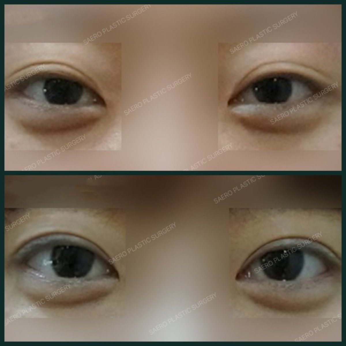Resultados antes y después de cirugía de doble párpado en SAERO Plastic Surgery, contorno mejorado