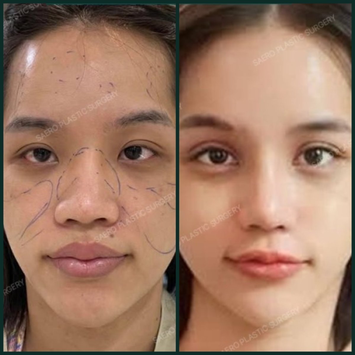 Resultados antes y después de cirugía de párpado doble en SAERO Plastic Surgery