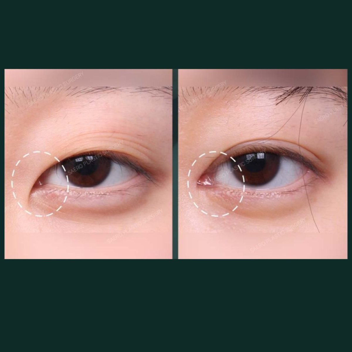 نتائج شد الجفن السفلي قبل وبعد في SAERO Plastic Surgery، تجديد شباب العين