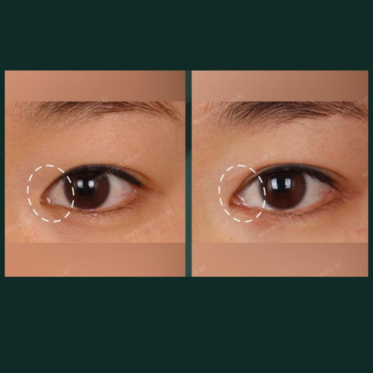 Resultados de blefaroplastia de párpado inferior antes y después en SAERO Plastic Surgery