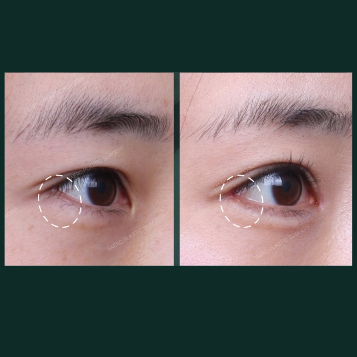 نتائج شد الجفن السفلي قبل وبعد في SAERO Plastic Surgery، تجديد شباب العين