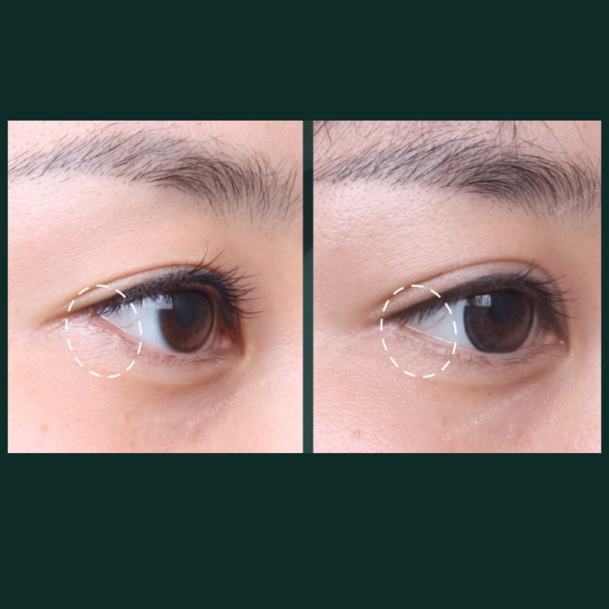 Before and after lower eyelid blepharoplasty results at SAERO Plastic Surgery, eye rejuvenation
