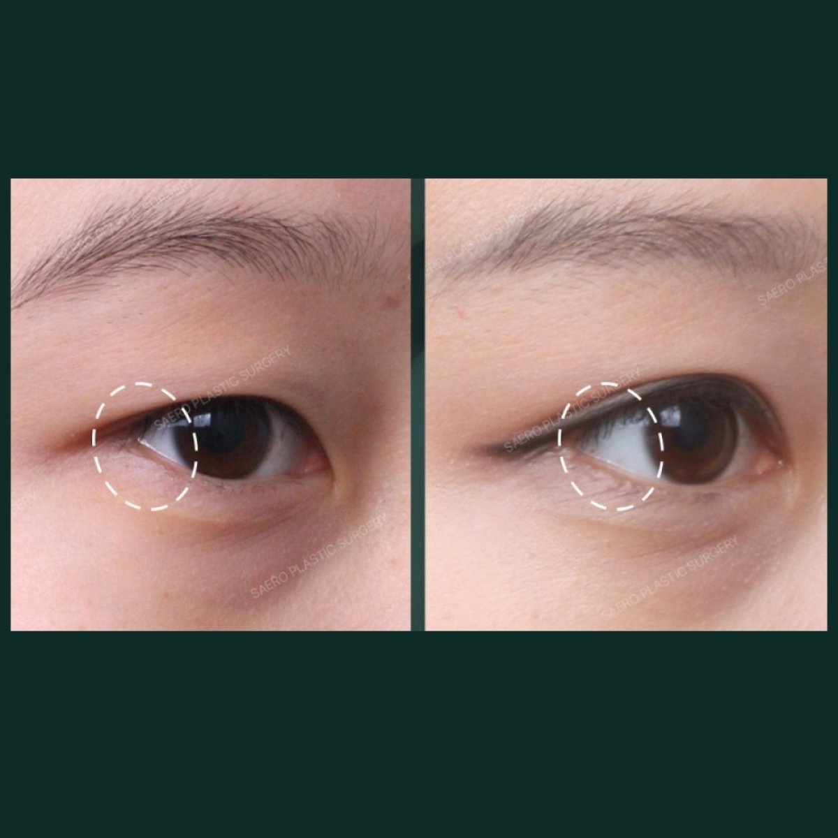 Lower eyelid blepharoplasty before and after results at SAERO Plastic Surgery, eye rejuvenation
