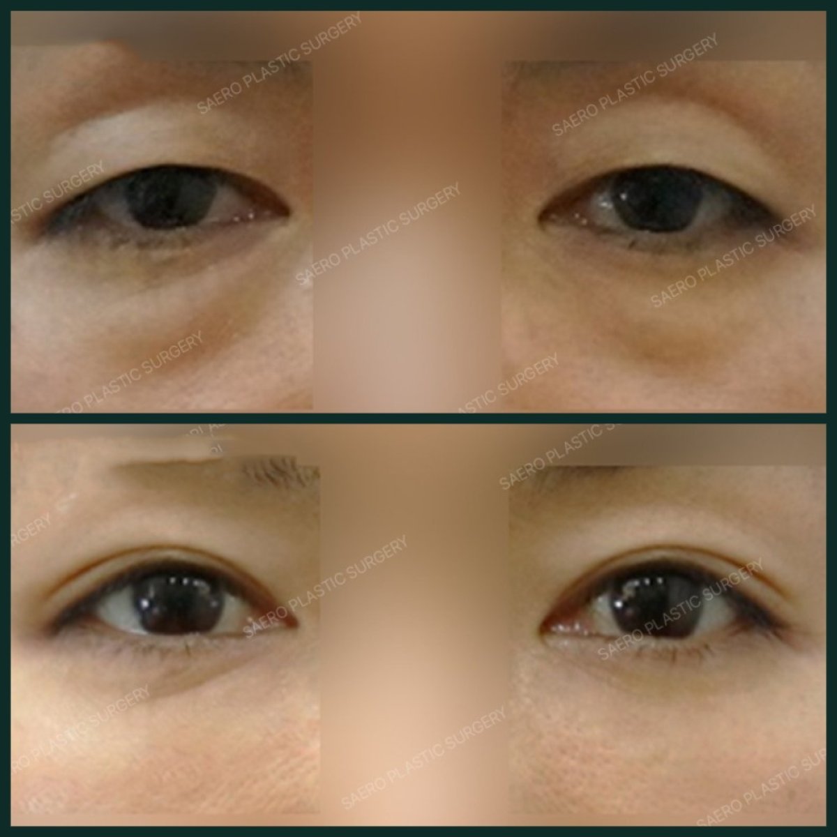 نتائج شد الجفن السفلي قبل وبعد في SAERO Plastic Surgery، تجديد شباب العينين