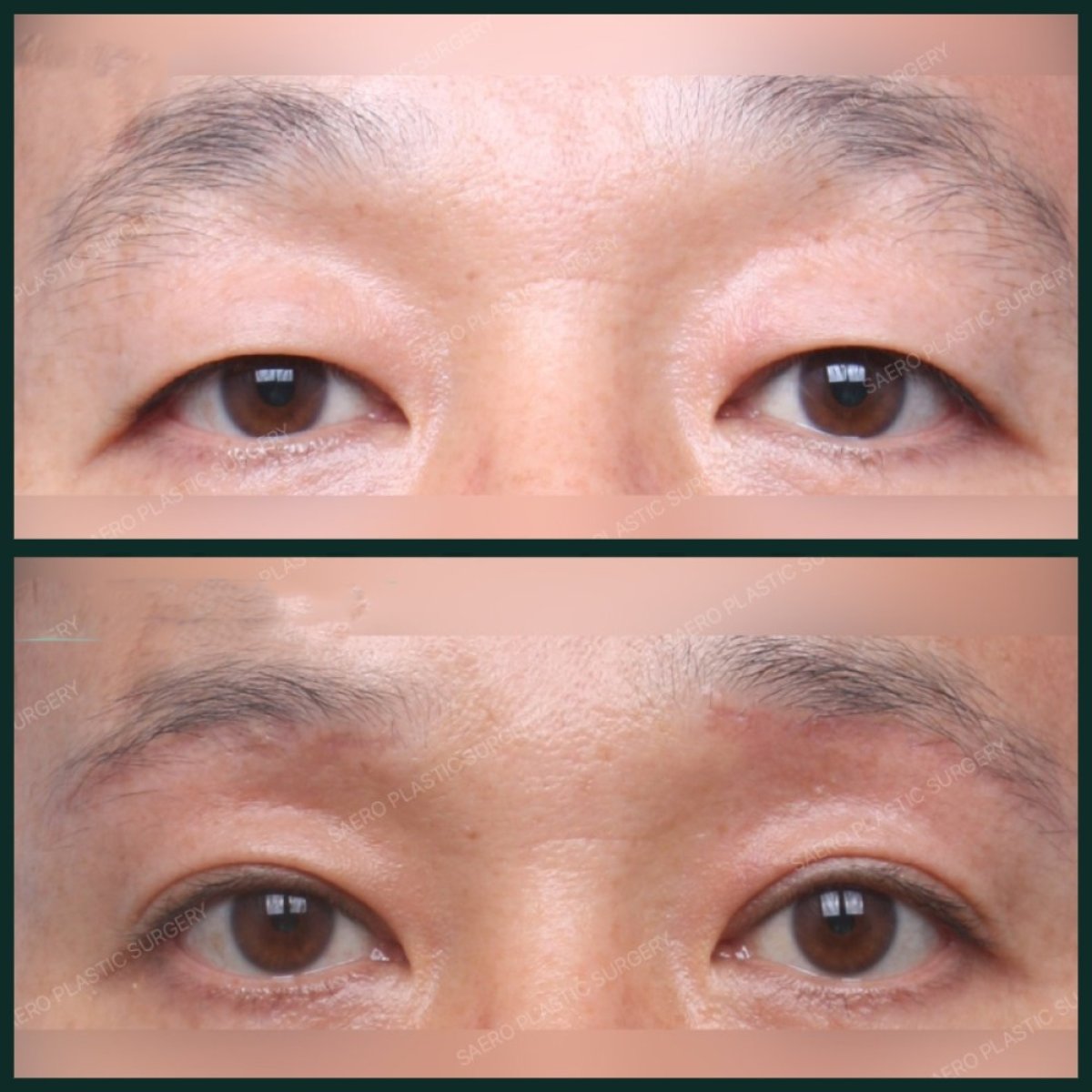 Résultats avant/après blépharoplastie inférieure chez SAERO Plastic Surgery, rajeunissement des yeux