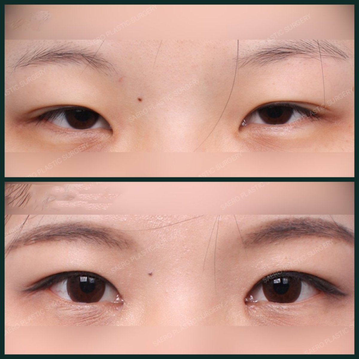 نتائج جراحة الجفن العلوي قبل وبعد في SAERO Plastic Surgery، تحسين شكل العين