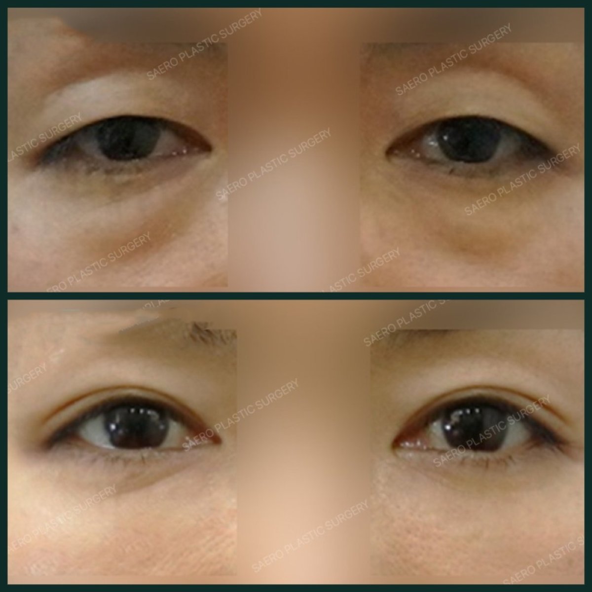 نتائج قبل وبعد جراحة الجفن العلوي في SAERO Plastic Surgery، تجديد منطقة العين