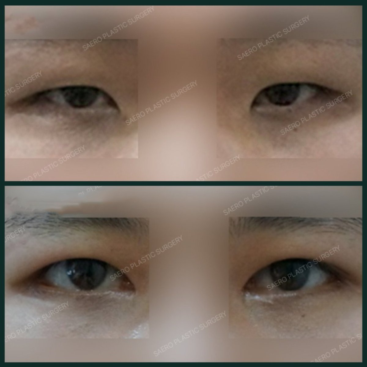 Resultados de blefaroplastia superior antes y después en SAERO Plastic Surgery, ojos mejorados