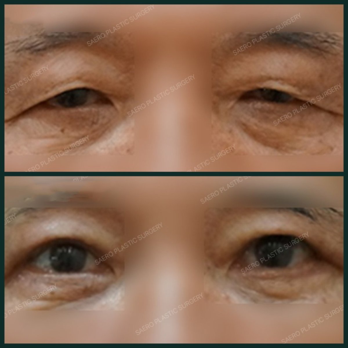 نتائج جراحة الجفن العلوي قبل وبعد في SAERO Plastic Surgery، تجديد منطقة العين