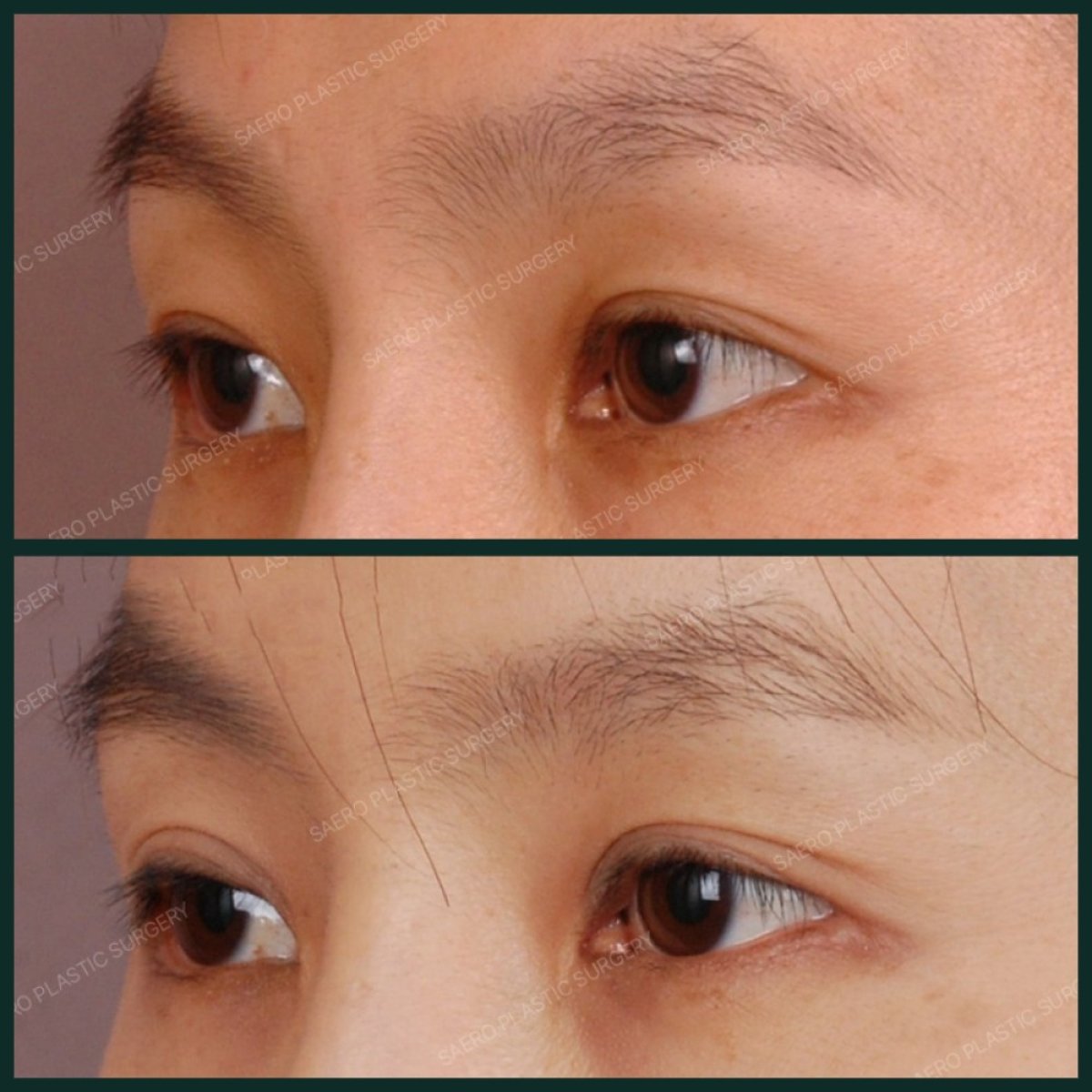 نتائج عملية الجفن العلوي قبل وبعد في SAERO Plastic Surgery، تحسين شكل العين