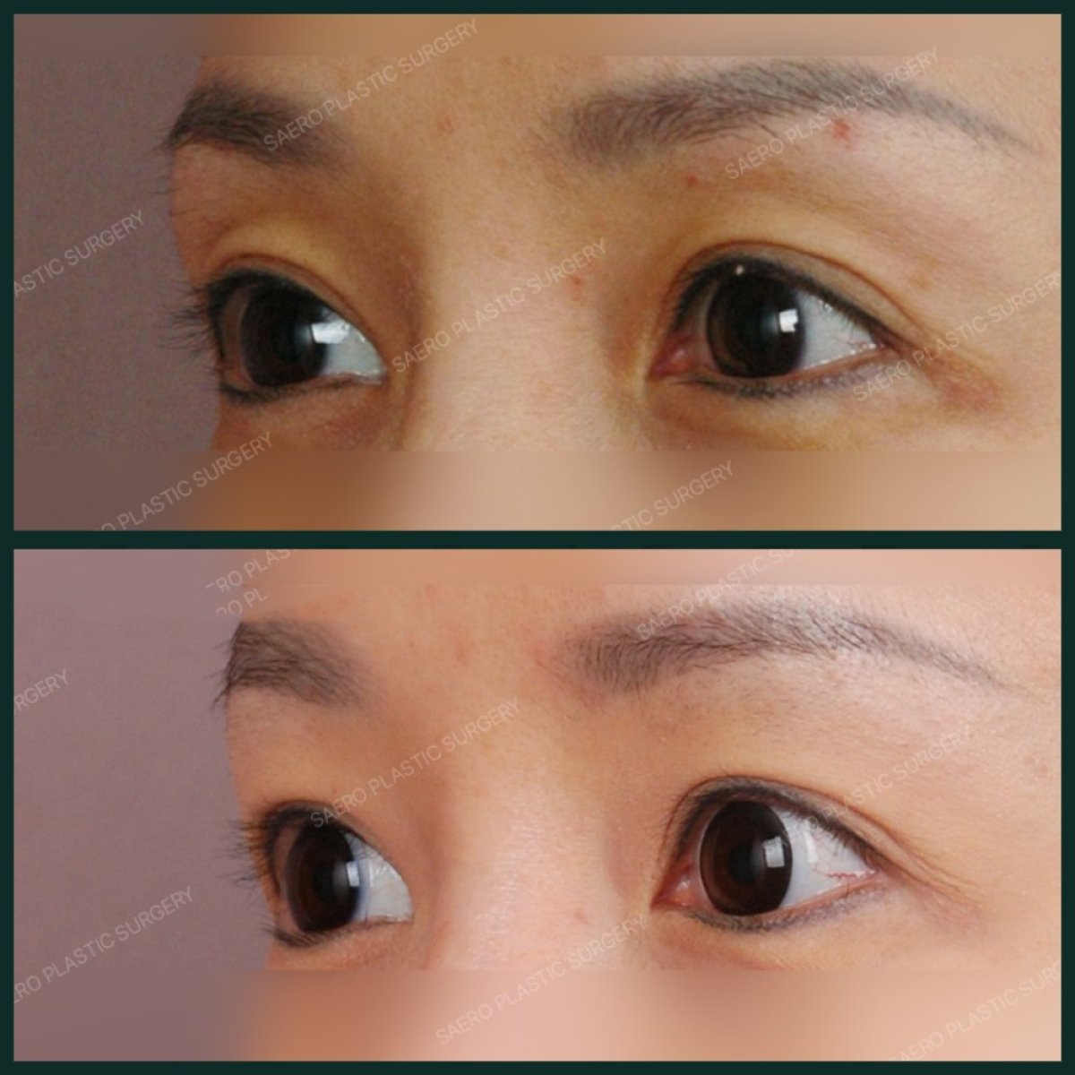 نتائج قبل وبعد جراحة الجفن العلوي في SAERO Plastic Surgery، تحسين شكل الجفن