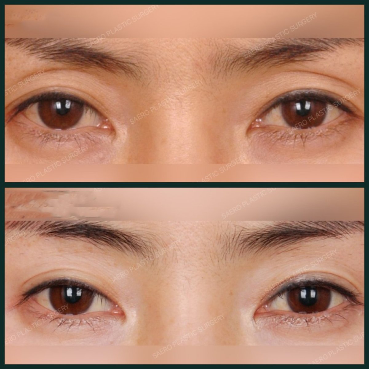 Before and after upper eyelid surgery results at SAERO Plastic Surgery, eyelid lift improvement