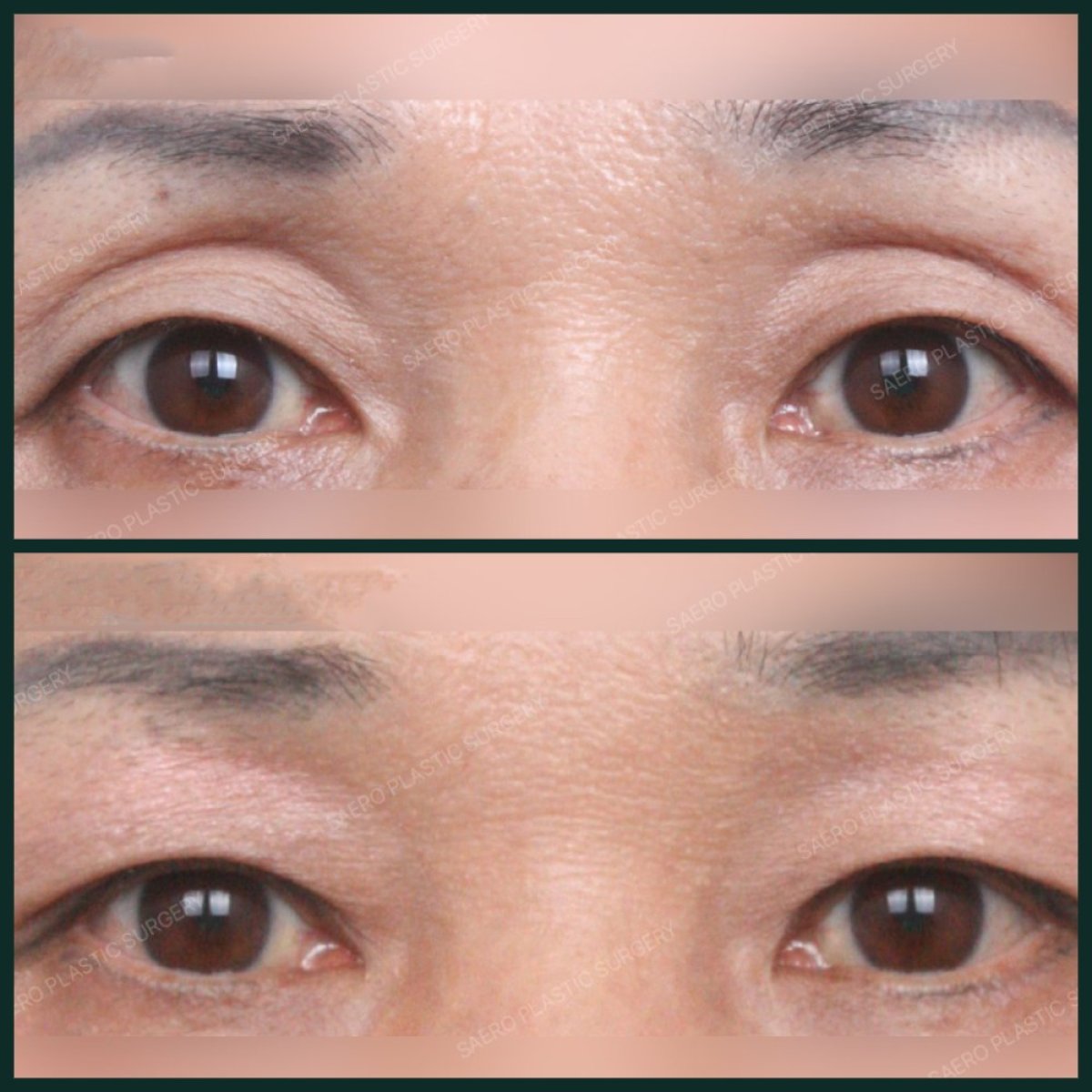 Upper eyelid surgery before and after results at SAERO Plastic Surgery, eyelid lift improvement