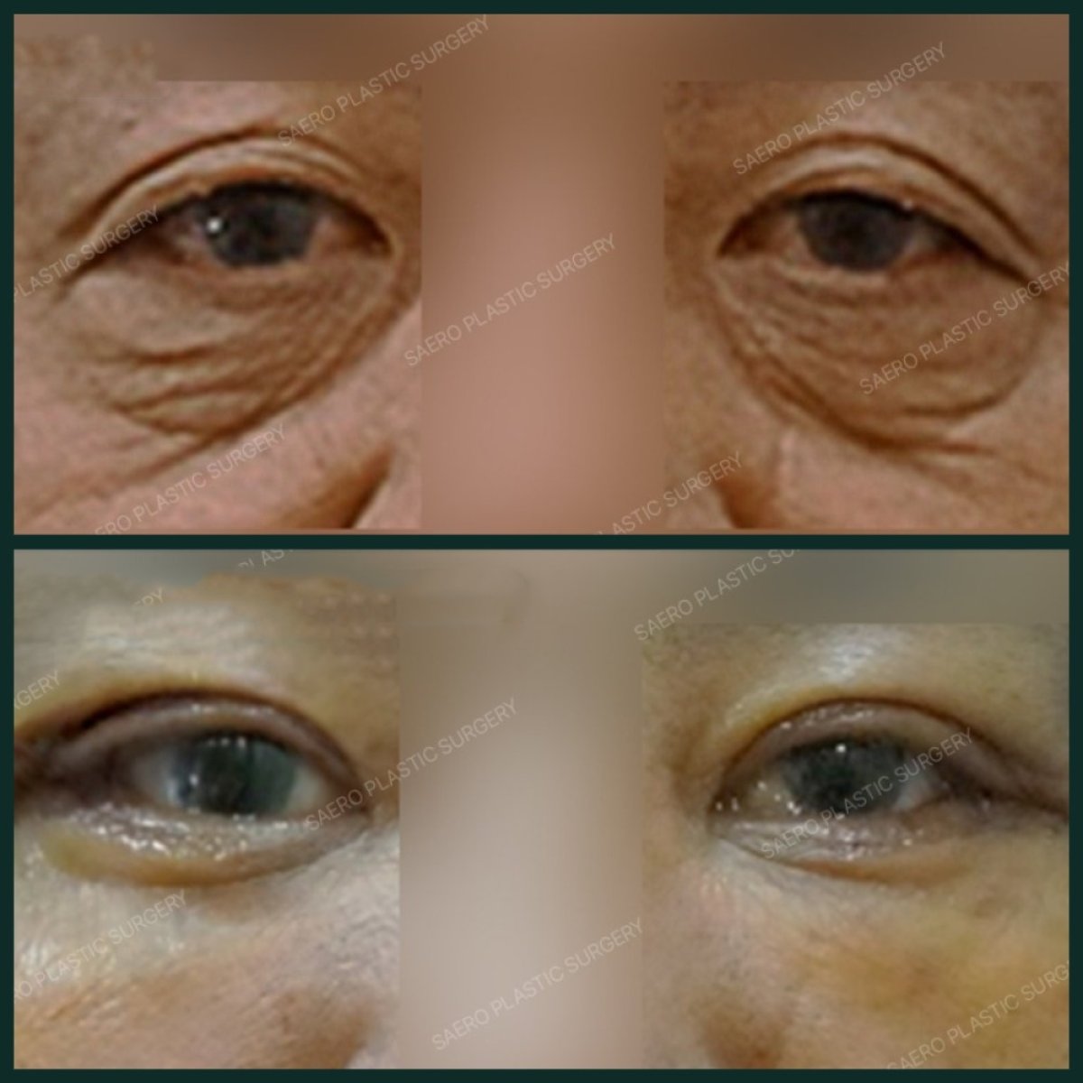 نتائج عملية شد الجفون العلوية والسفلية في SAERO Plastic Surgery، عيون أكثر شباباً