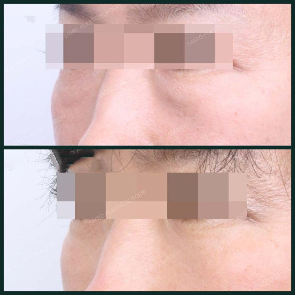 نتيجة نقل دهون الوجه في SAERO Plastic Surgery، تحسين حجم تحت العين