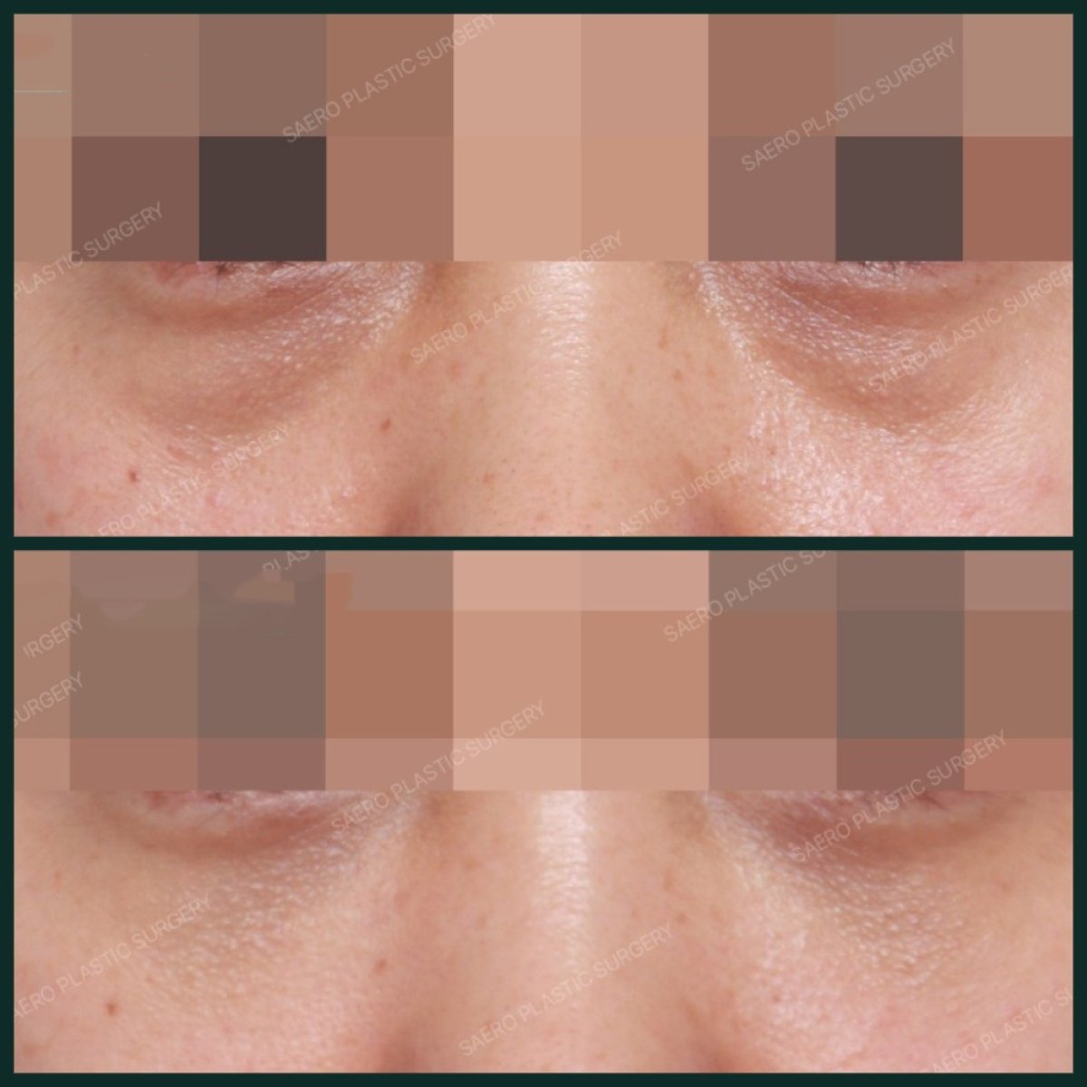 نتائج قبل وبعد نقل الدهون للوجه في SAERO Plastic Surgery، تحسين حجم تحت العين