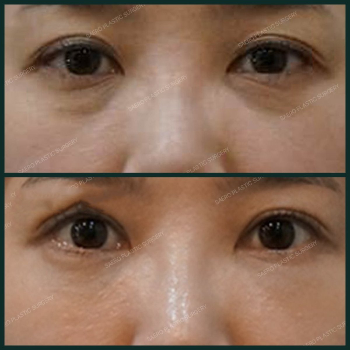 نتائج قبل وبعد نقل دهون الوجه في SAERO Plastic Surgery، تجديد تحت العينين