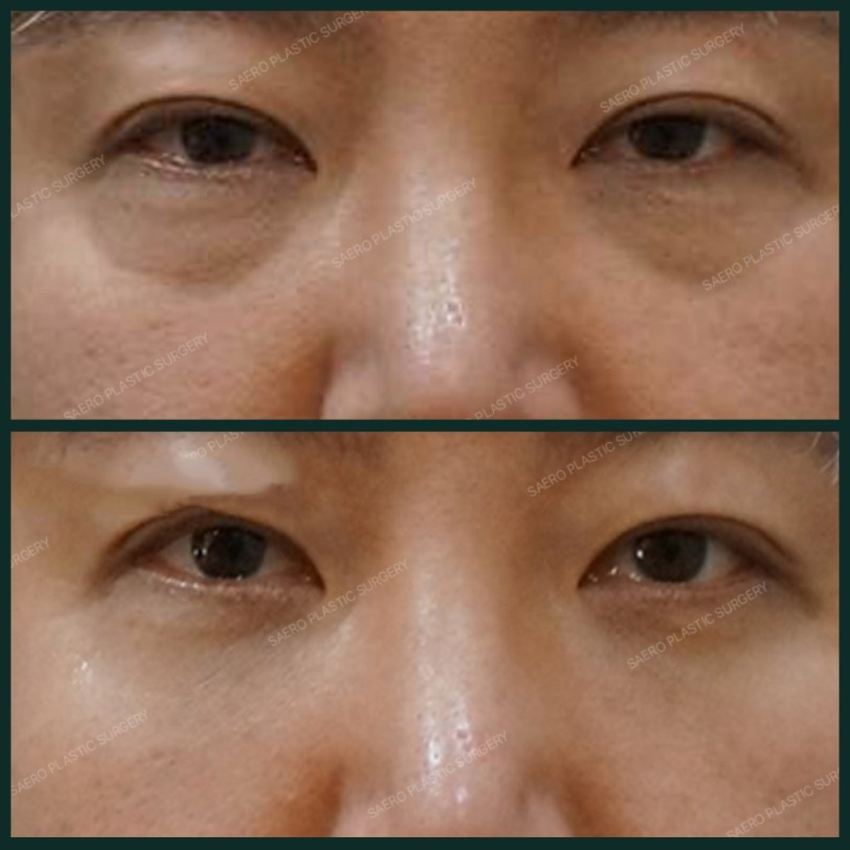 Before and after facial fat transfer at SAERO Plastic Surgery, under-eye rejuvenation result