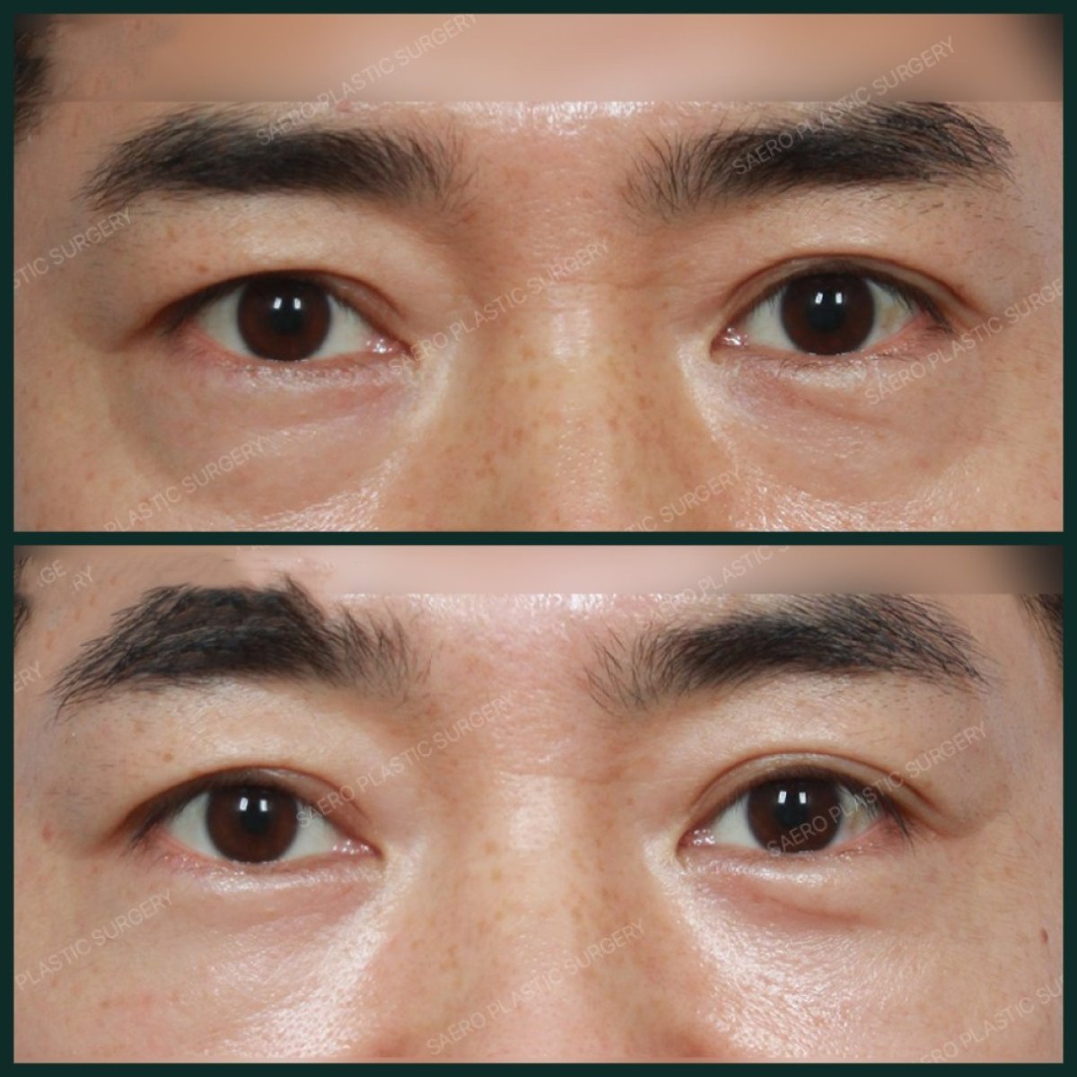 Before and after facial fat transfer at SAERO Plastic Surgery, under-eye volume improvement result