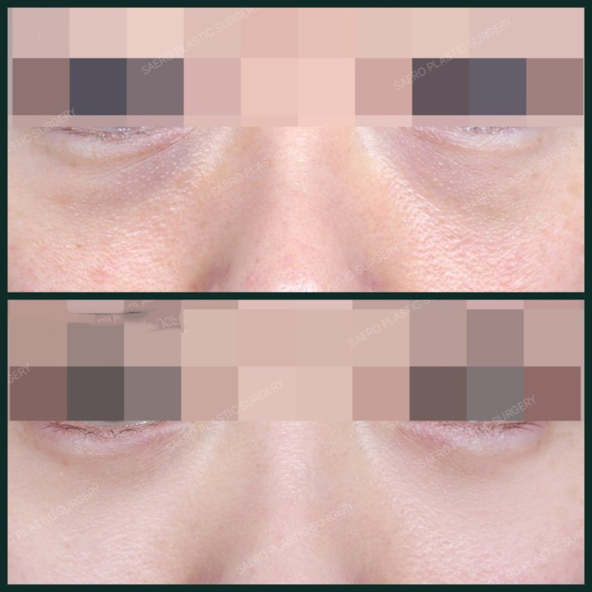 نتائج قبل وبعد نقل الدهون للوجه في SAERO Plastic Surgery، تحسين حجم تحت العين