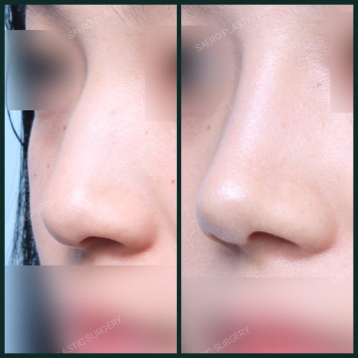 Before and after rhinoplasty results at SAERO Plastic Surgery, nose reshaping improvement