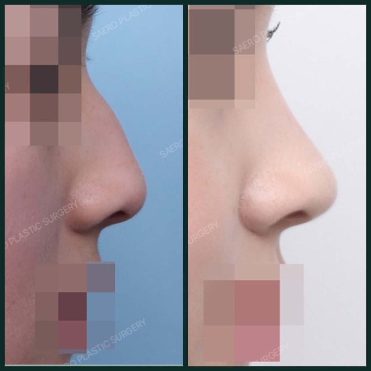 نتائج عملية تجميل الأنف قبل وبعد في SAERO Plastic Surgery، تحسين شكل الأنف الجانبي