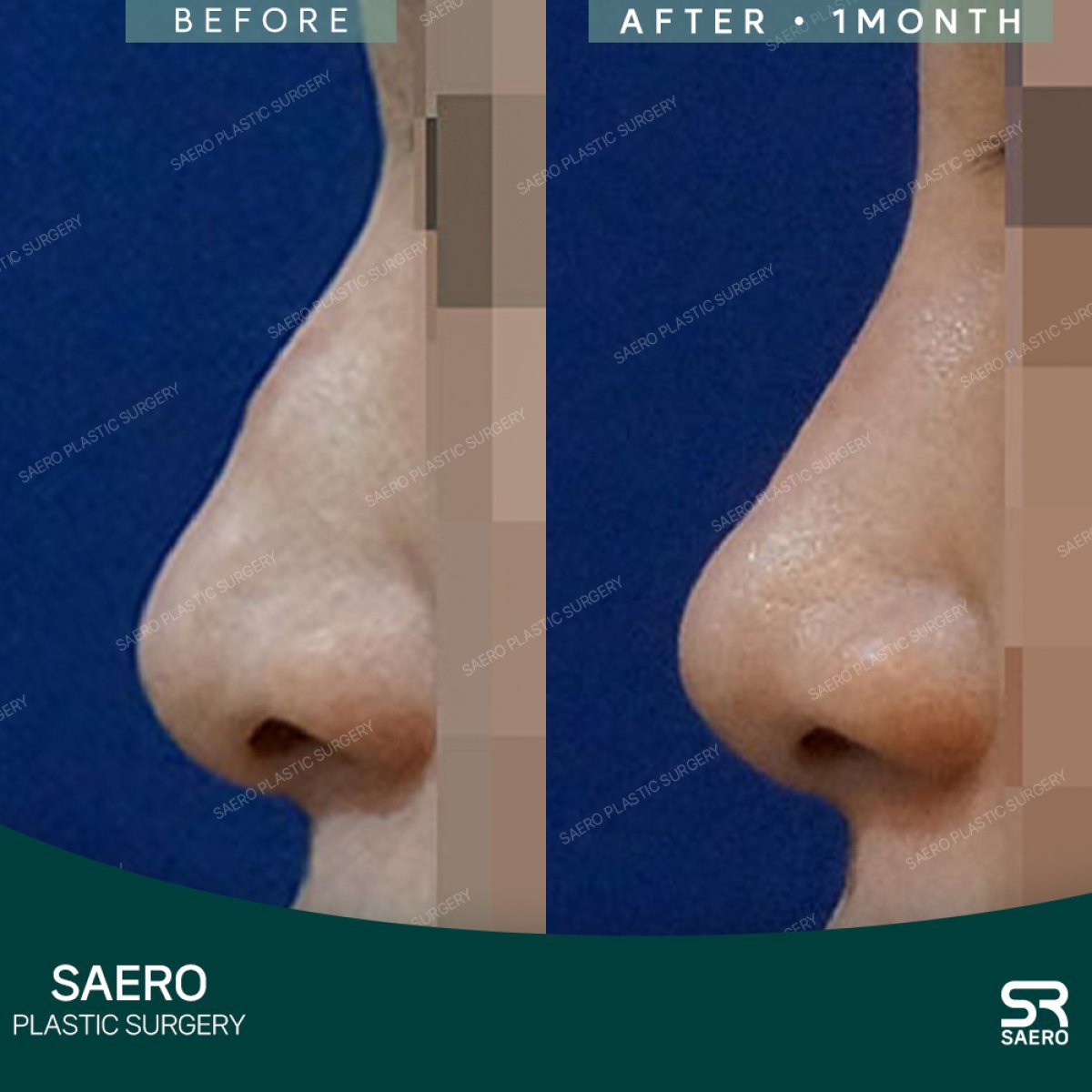 Результаты ринопластики до и после в SAERO Plastic Surgery, улучшенный профиль носа через месяц