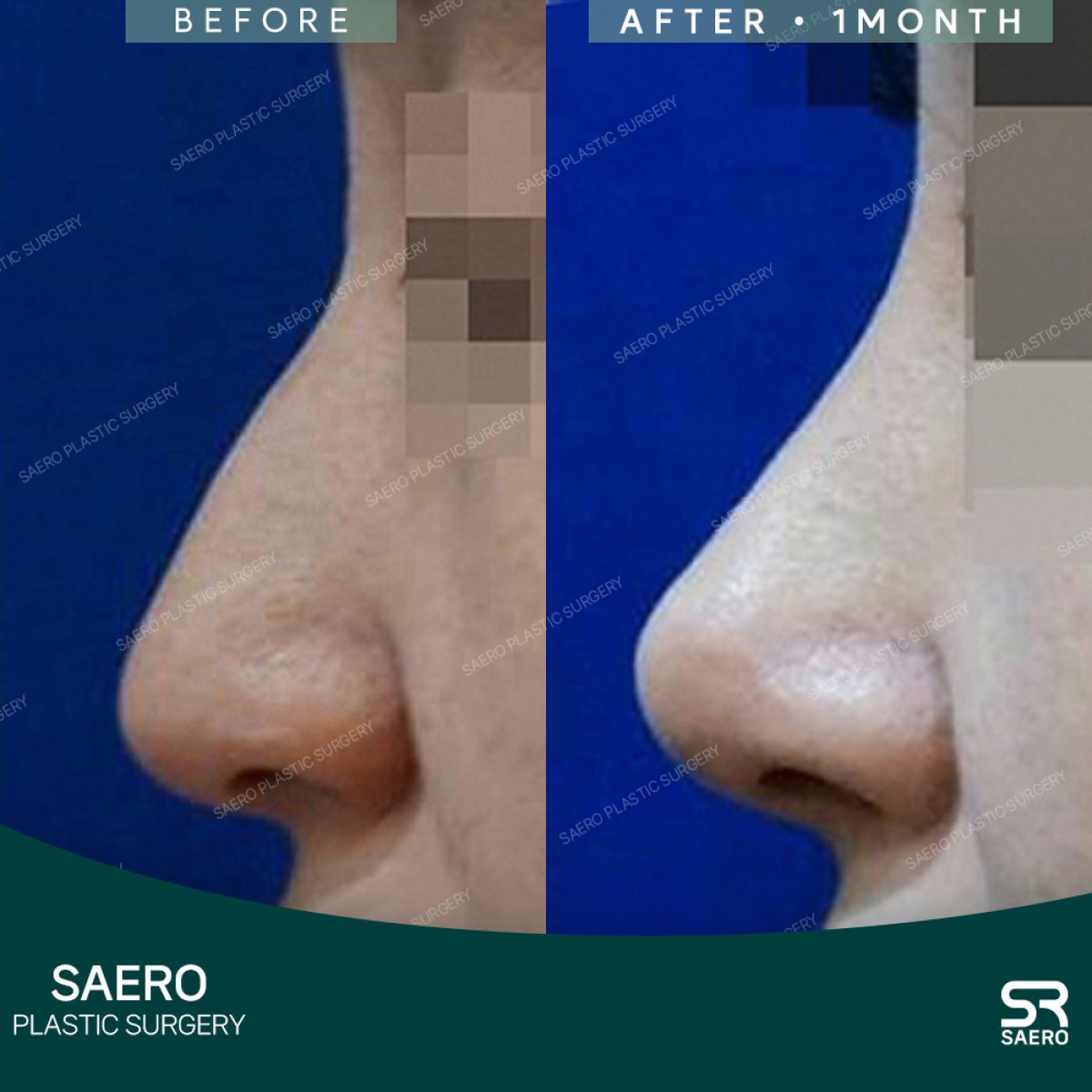 نتائج عملية تجميل الأنف قبل وبعد في SAERO Plastic Surgery، تحسن شكل الأنف بعد شهر