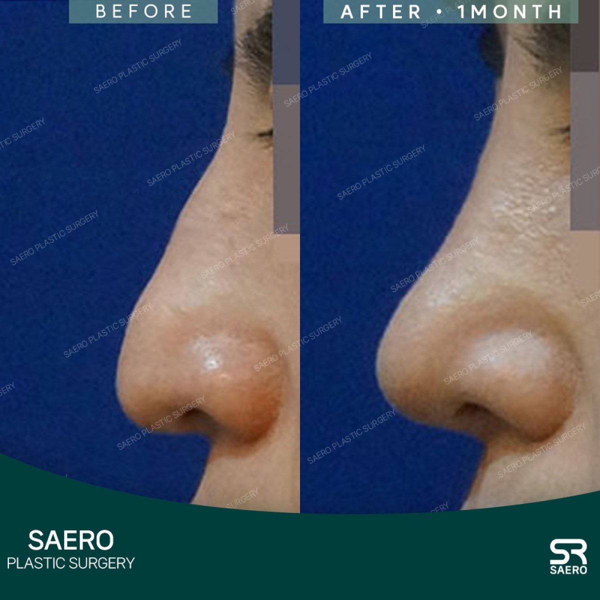 نتائج تجميل الأنف قبل وبعد في SAERO Plastic Surgery، تحسين شكل الأنف بعد شهر