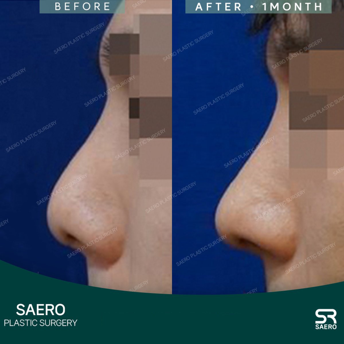 نتائج عملية تجميل الأنف قبل وبعد في SAERO Plastic Surgery، تحسين شكل الأنف بعد شهر