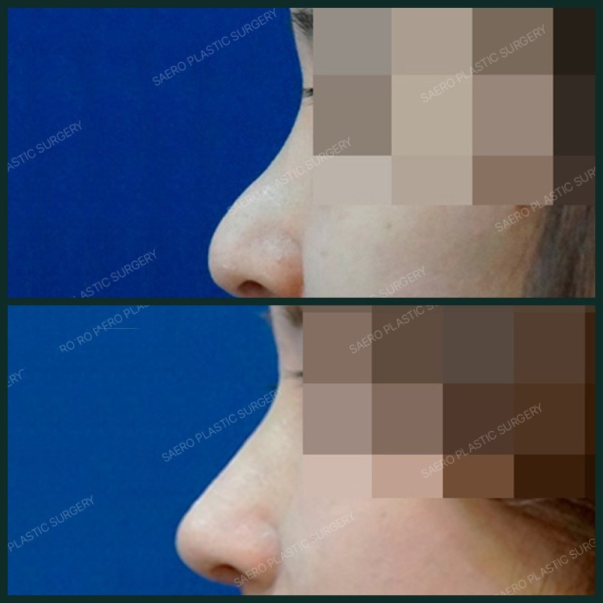نتائج عملية تجميل الأنف قبل وبعد في SAERO Plastic Surgery، تحسين شكل الأنف