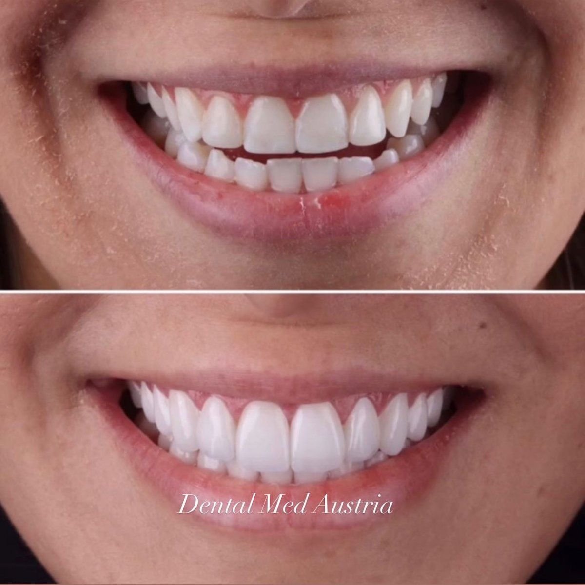 Before and after veneers result at Dental Med Austria & Elixence, smile transformation