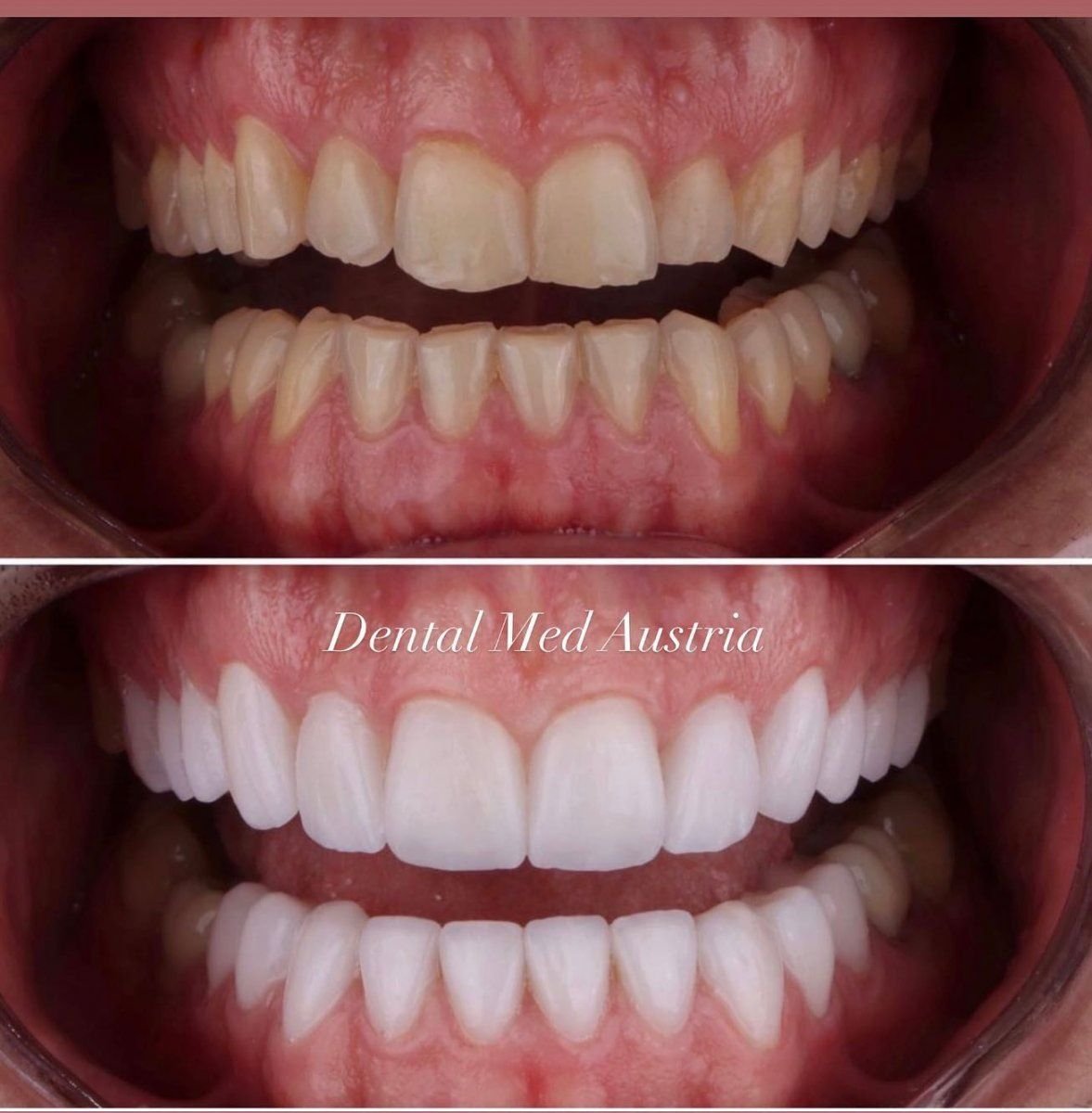 Before and after veneers at Dental Med Austria & Elixence – smile transformation results