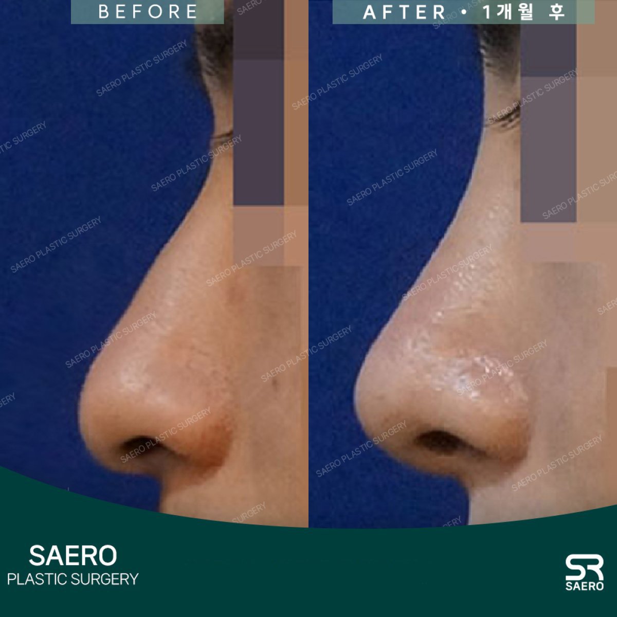 نتائج تجميل الأنف قبل وبعد في SAERO Plastic Surgery، تحسين شكل الأنف الجانبي