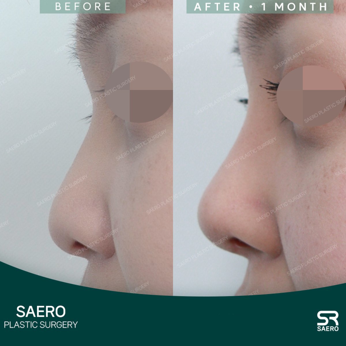 نتائج تجميل الأنف قبل وبعد في SAERO Plastic Surgery، تحسين شكل الأنف بعد شهر