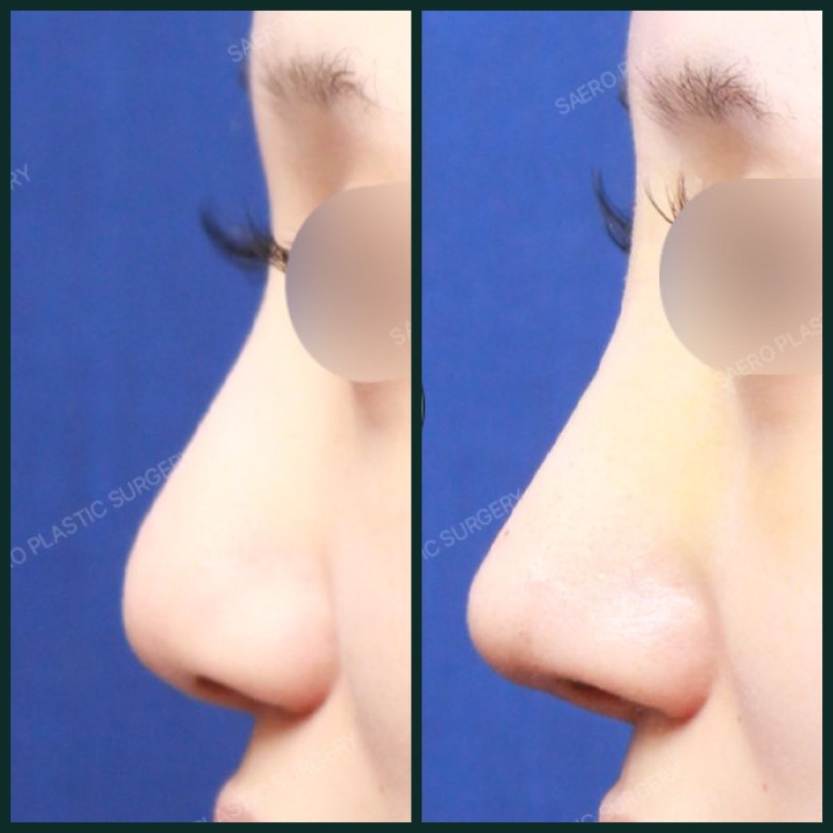 نتائج عملية تجميل الأنف قبل وبعد في SAERO Plastic Surgery، تحسين شكل الأنف