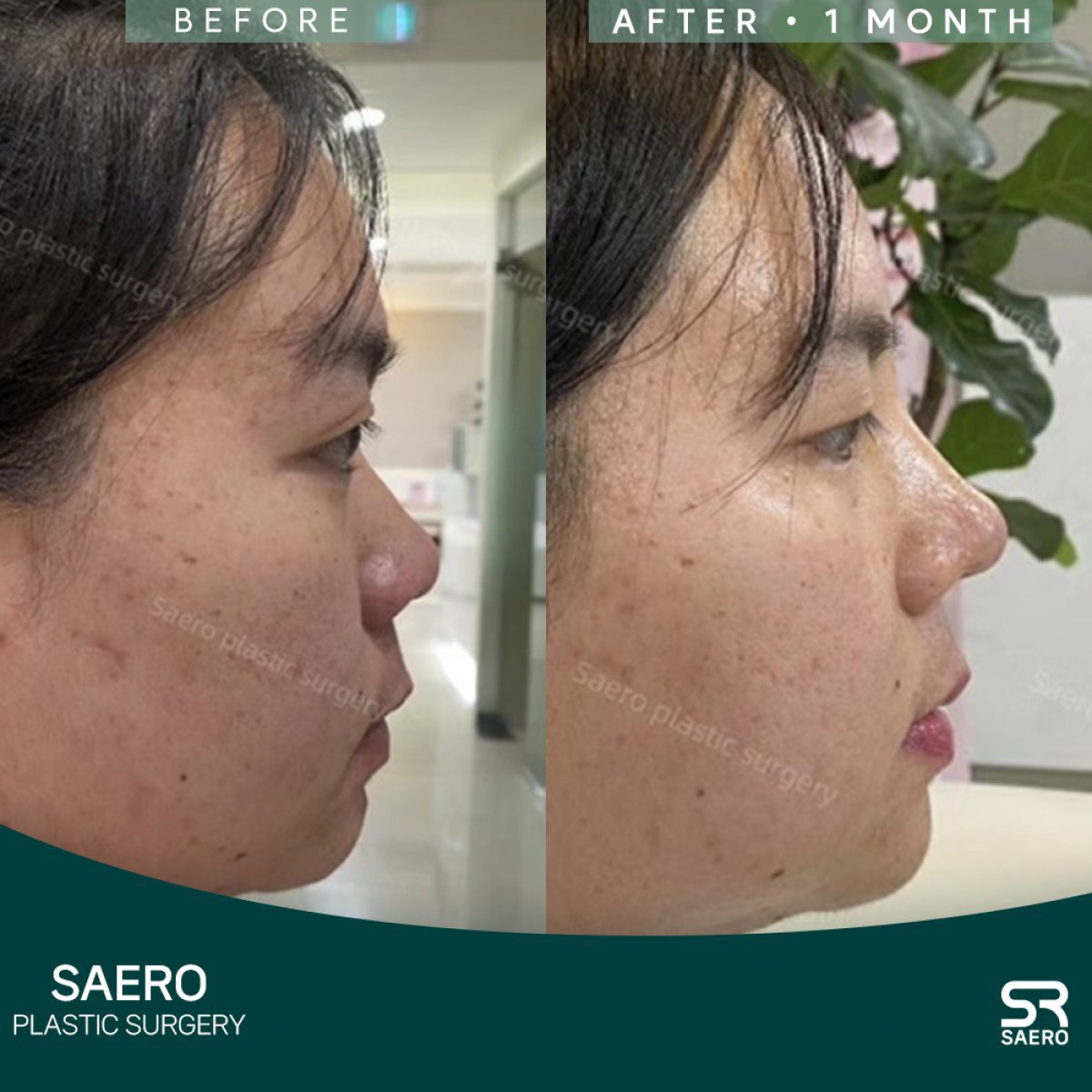 Resultados de rinoplastia antes y después en SAERO Plastic Surgery, perfil nasal mejorado en 1 mes