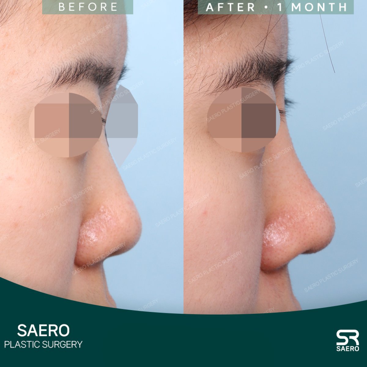 Resultado de rinoplastia antes y después en SAERO Plastic Surgery, perfil nasal mejorado en 1 mes