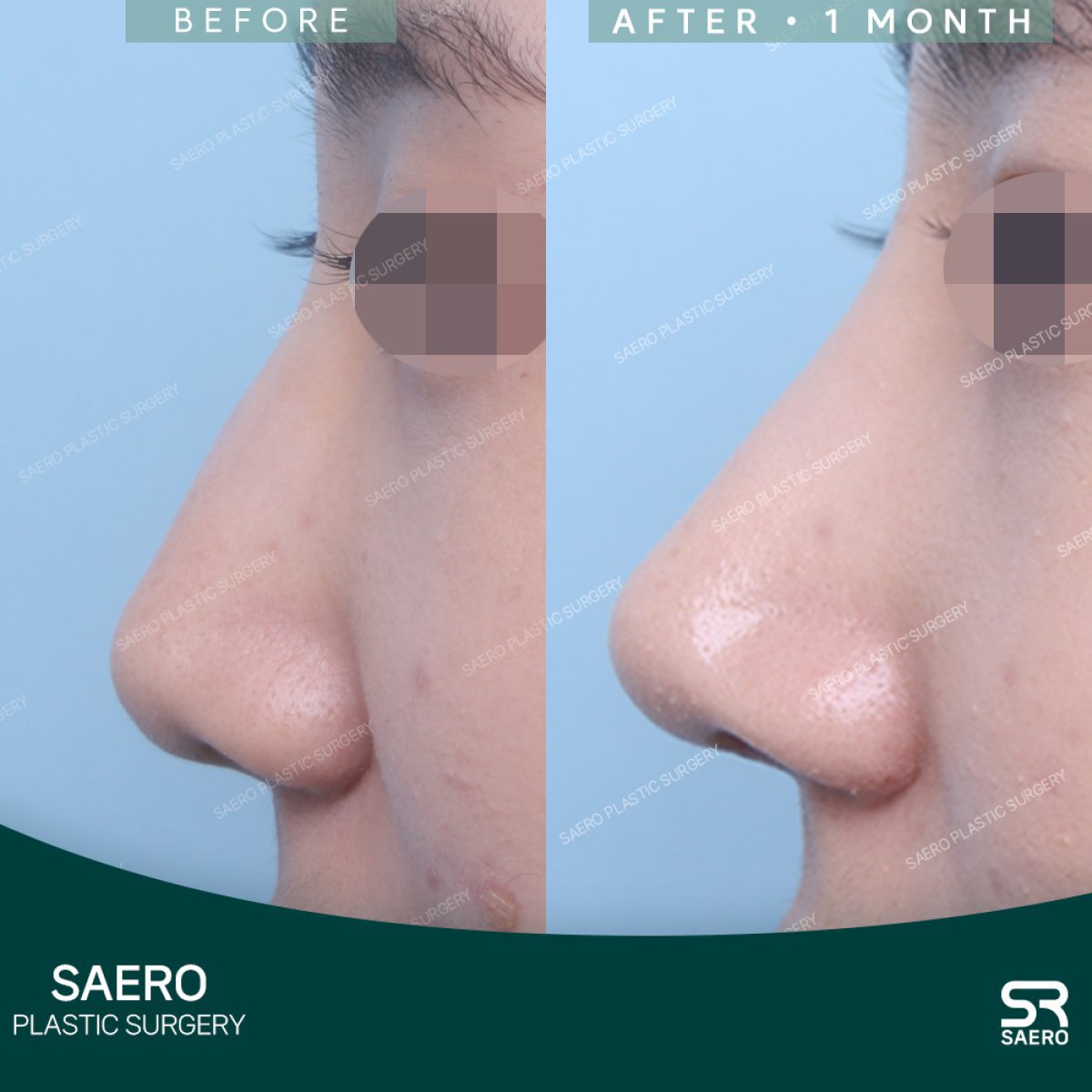 نتائج عملية تجميل الأنف قبل وبعد في SAERO Plastic Surgery، تعديل الأنف بعد شهر