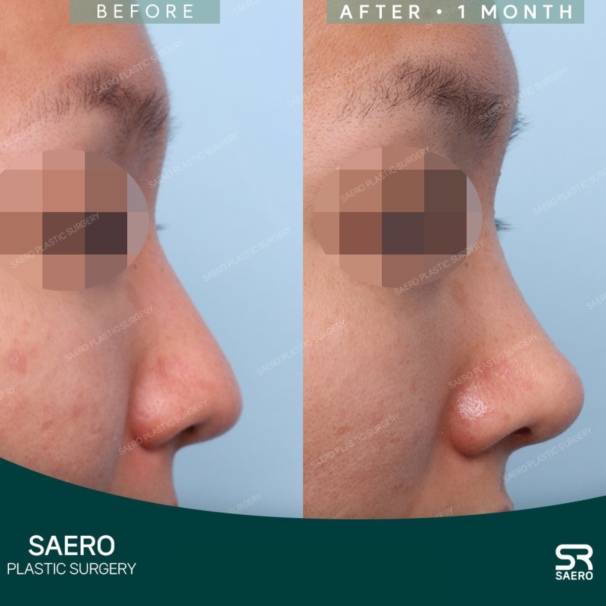 نتائج عملية تجميل الأنف قبل وبعد في SAERO Plastic Surgery، تعديل الأنف بعد شهر واحد
