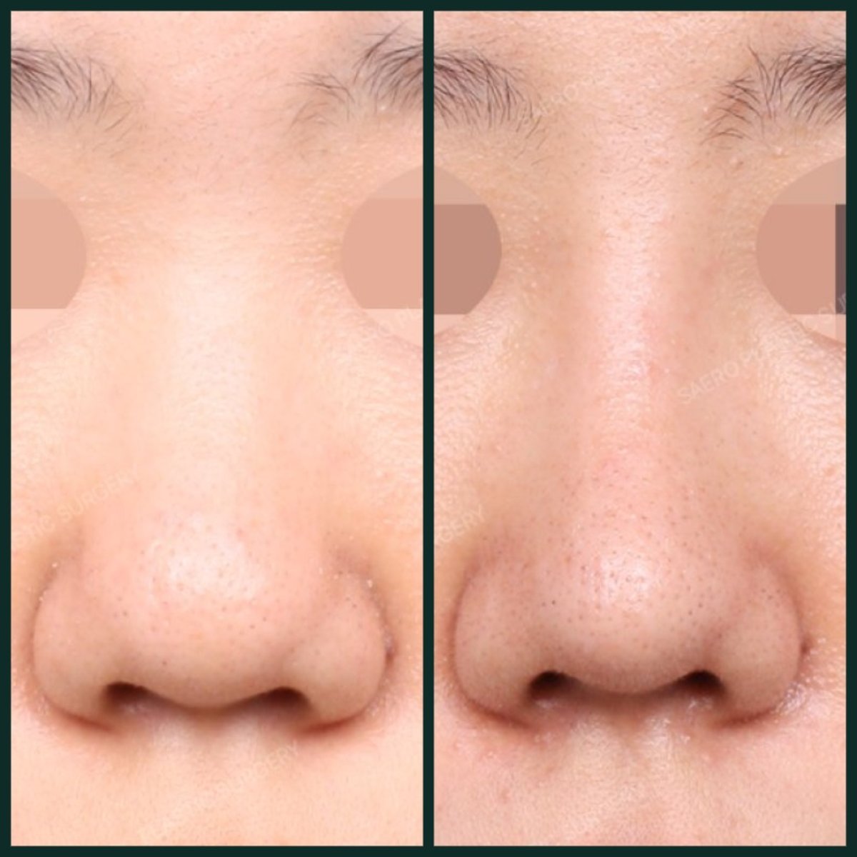 نتائج عملية تجميل الأنف قبل وبعد في SAERO Plastic Surgery، تحسين شكل الأنف