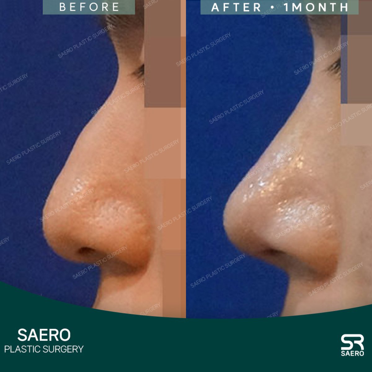 نتائج عملية تجميل الأنف بالعظم قبل وبعد شهر في SAERO Plastic Surgery، إعادة تشكيل الأنف