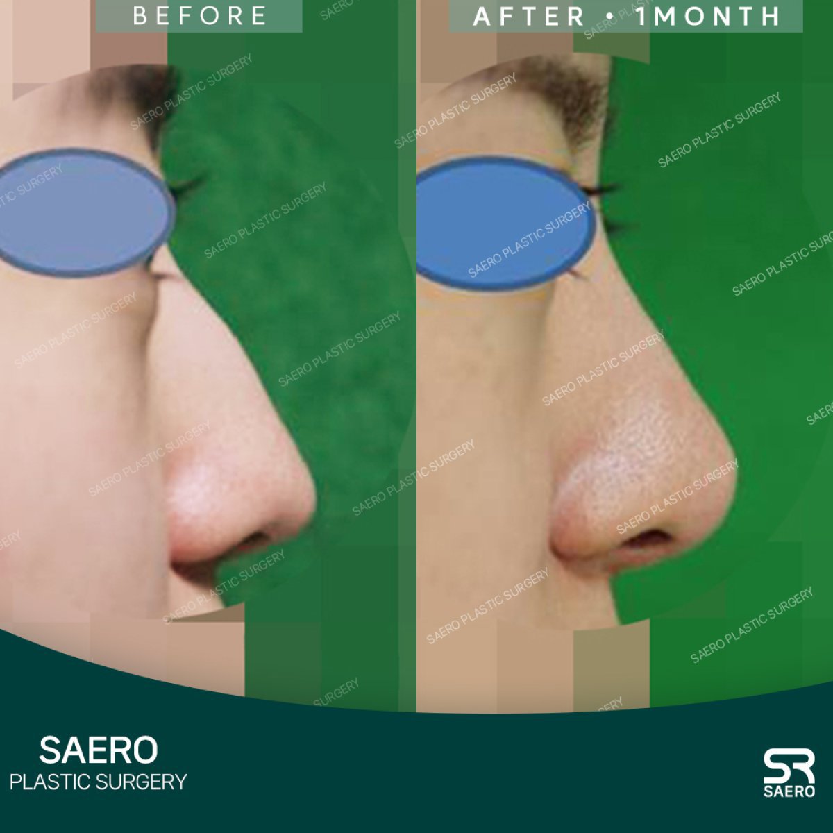 نتائج تجميل الأنف بالأوستيوتومي قبل وبعد في SAERO Plastic Surgery، تحسين شكل الأنف
